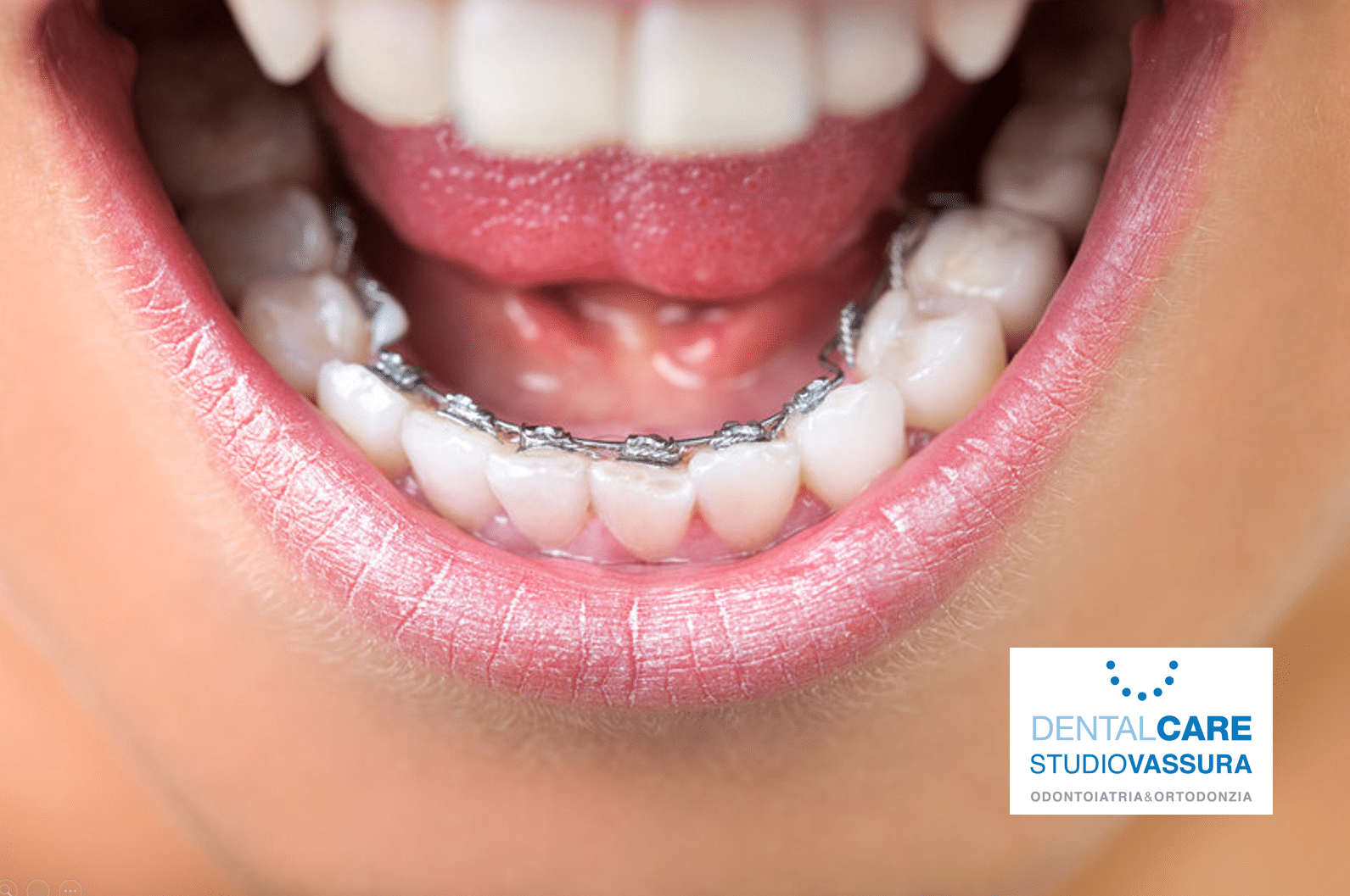 apparecchio ortodontico linguale