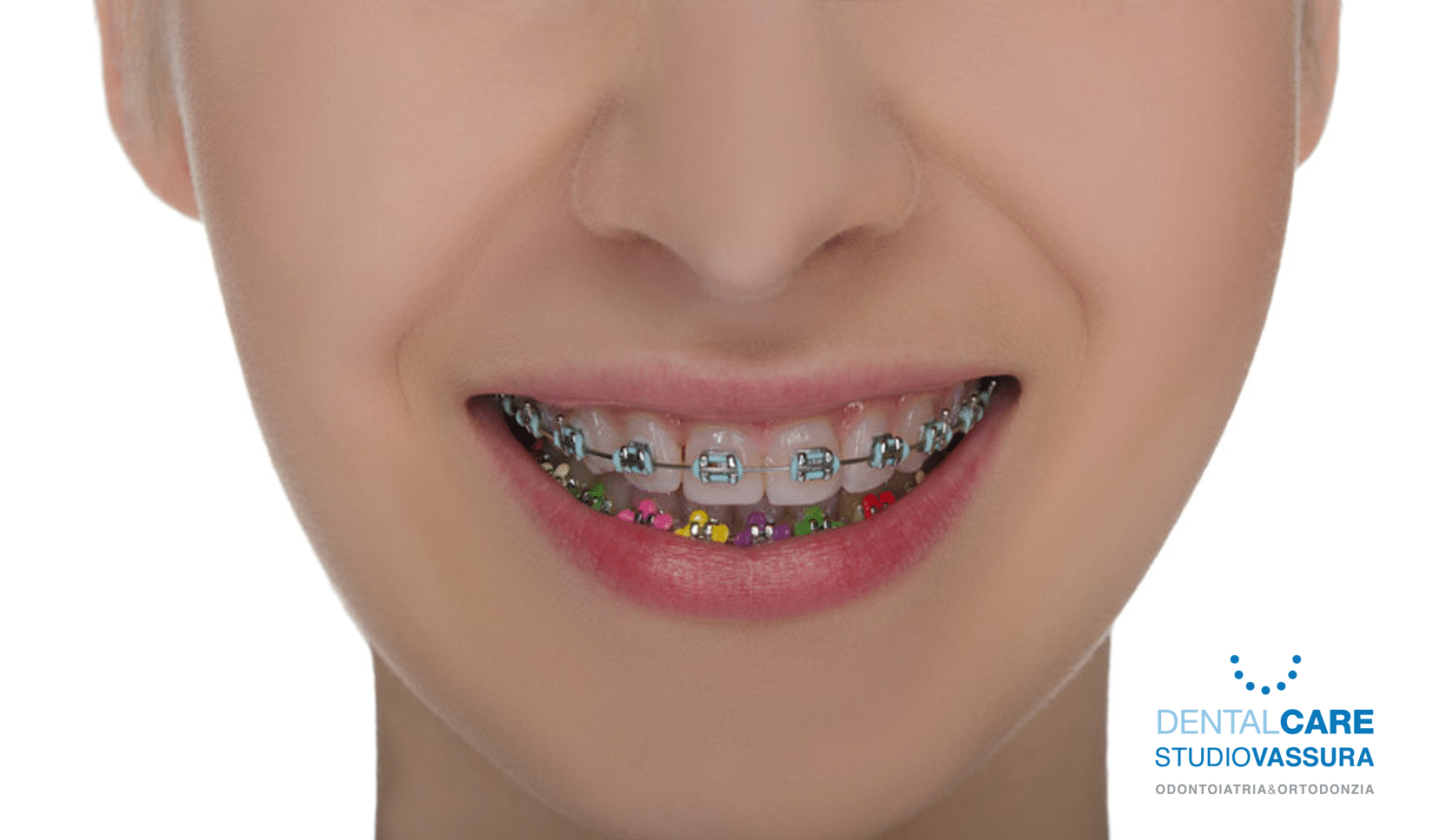 apparecchio ortodontico fisso colorato