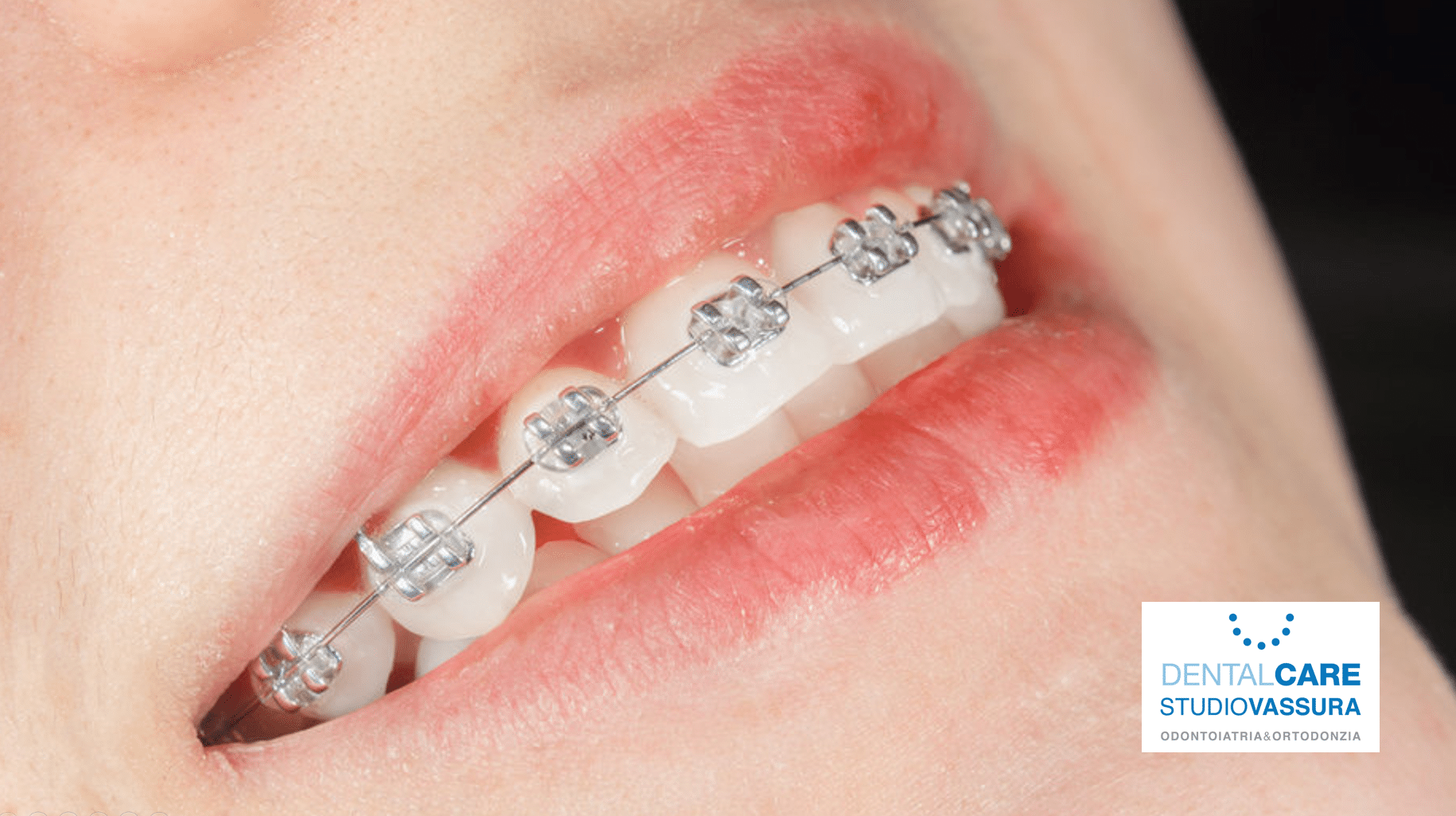 apparecchio ortodontico metallico