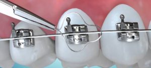 apparecchio ortodontico per adulti